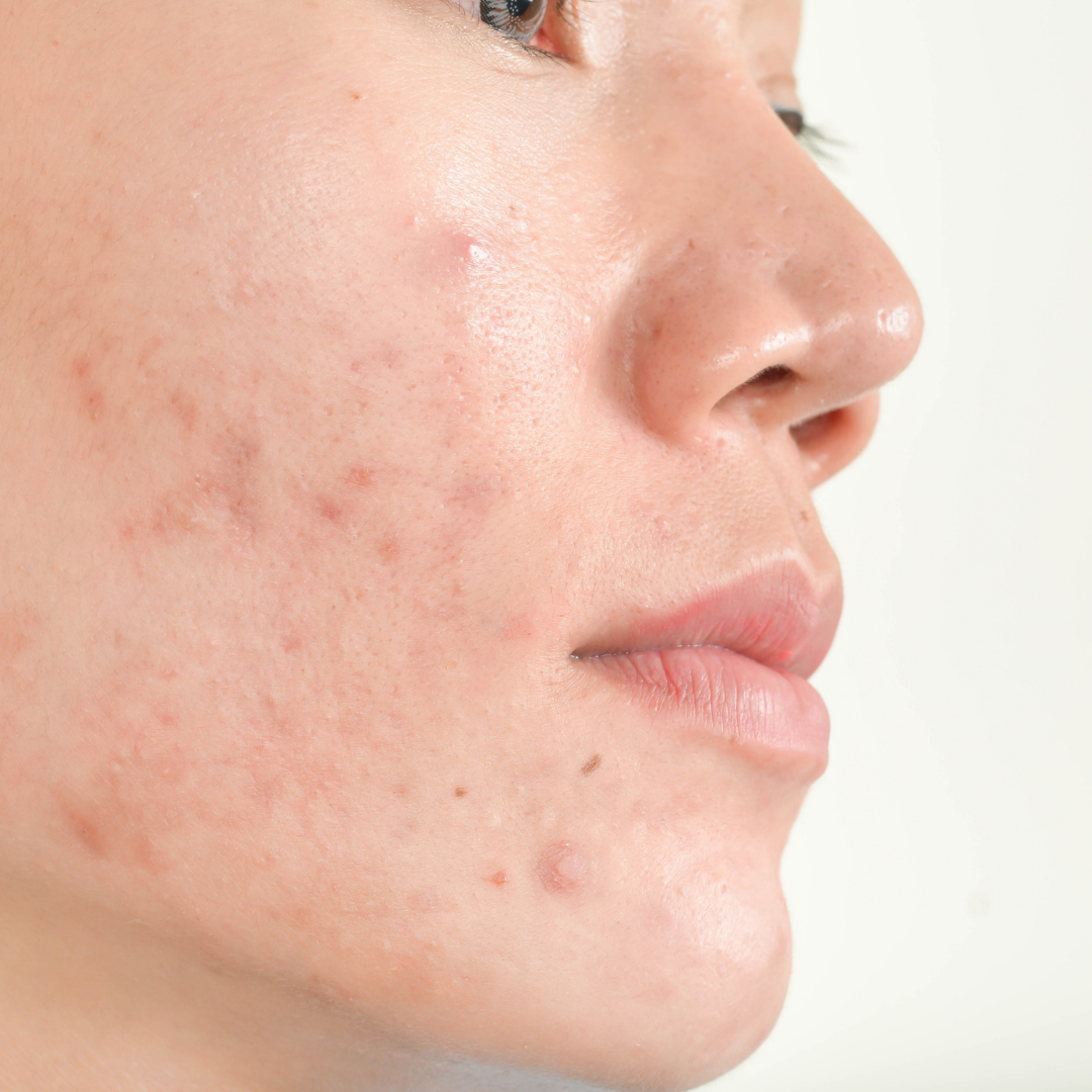 Hyperpigmentation Labothecaire Blog Post